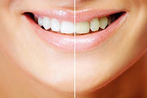 Hvitere tenner - fr etter - Dentalia